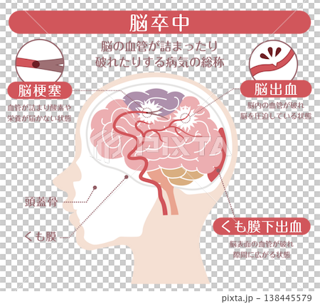 脳卒中の種類比較イラスト（脳梗塞・脳出血・くも膜下出血） 138445579