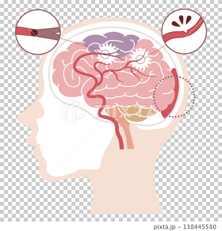 脳卒中の種類比較イラスト（脳梗塞・脳出血・くも膜下出血） 138445580