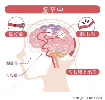 脳卒中の種類比較イラスト(脳梗塞・脳出血・くも膜下出血) 脳卒中の種類比較イラスト(脳梗塞・脳出血・くも膜下出血) 138445581