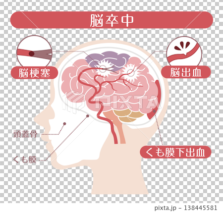 脳卒中の種類比較イラスト(脳梗塞・脳出血・くも膜下出血) 脳卒中の種類比較イラスト(脳梗塞・脳出血・くも膜下出血) 138445581