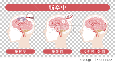 中風類型（腦梗塞、腦出血、蜘蛛網膜下腔出血）－醫學插圖 138445582