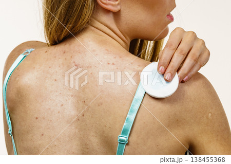 Woman acne on back cleaning skin with tonic 138455368