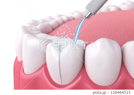 3D render of a dental irrigator cleaning a molar tooth 3D render of a dental irrigator cleaning a molar tooth 138464515