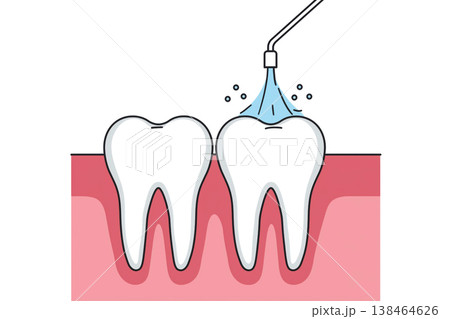 Educational illustration of a water flosser cleaning between molars 138464626