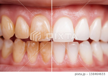 Front Teeth Whitening Before and After Results Front Teeth Whitening Before and After Results 138464633