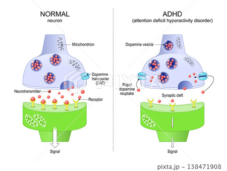 Normal neuron and ADHD neuron. Attention deficit hyperactivity disorder. 138471908
