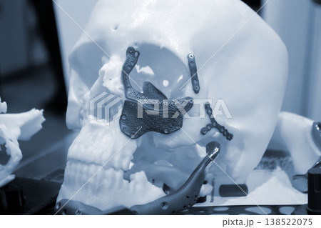 Prototype of human skull from white plastic with titanium implants of plates and surgical templates printed on 3D printer. Biointegrated prosthesis. Medicine medical. Endoprosthesis Prototype of human skull from white plastic with titanium implants of plates and surgical templates printed on 3D printer. Biointegrated prosthesis. Medicine medical. Endoprosthesis 138522075