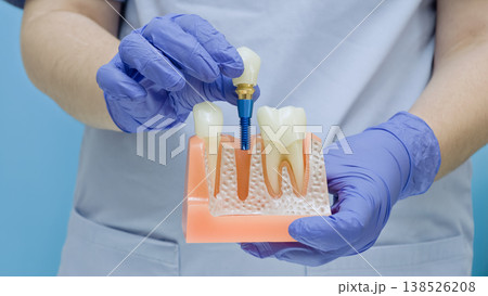 Dentist's hands in blue gloves demonstrating the placement of a dental implant with crown into a jaw bone model. Dentist's hands in blue gloves demonstrating the placement of a dental implant with crown into a jaw bone model. 138526208
