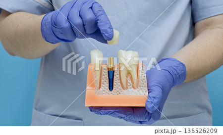 Dentist hands in blue gloves placing a ceramic crown on a dental implant abutment using a jaw anatomical model. Dentist hands in blue gloves placing a ceramic crown on a dental implant abutment using a jaw anatomical model. 138526209