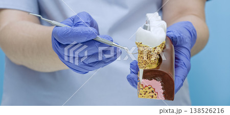 Dentist pointing at dental tartar and gum disease on anatomical tooth model with professional probe. 138526216