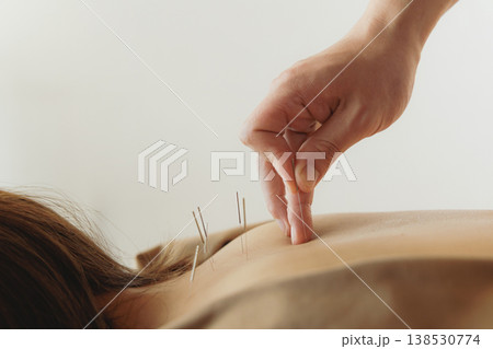 鍼灸治療の施術風景 鍼を打つ手元のアップと女性の背中の近影 138530774
