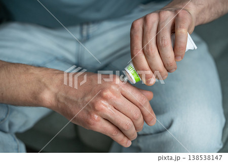 Male applying natural cosmetic moisturizing cream from tube on dry hands skin to cure frostbite. 138538147