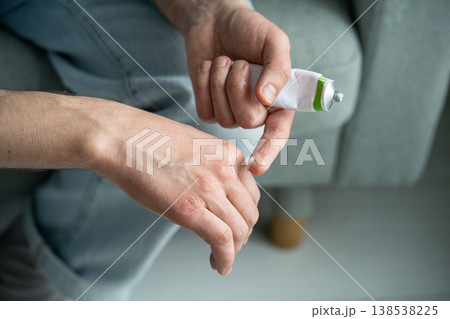 Hand care treatment and cold weather in winter season, man applying cosmetic cream to heal sore skin Hand care treatment and cold weather in winter season, man applying cosmetic cream to heal sore skin 138538225