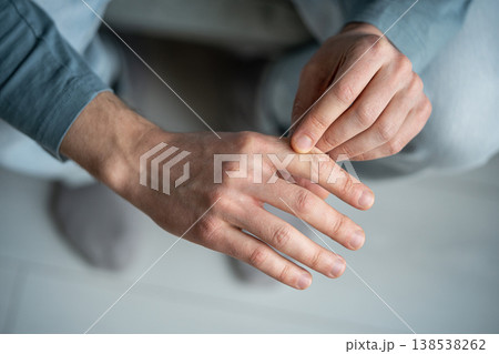 Male with hand skin dryness between fingers, symptoms of dehydration or seasonal vitamin deficiency. 138538262