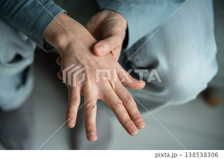 Dehydration, lack of electrolytes and vitamin deficiency, man suffering from skin dryness, on hands. 138538306