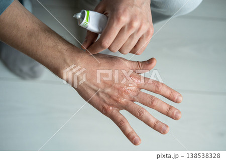 Man applying gel on painful areas of hands skin to cure cracks and dryness caused by winter season. Man applying gel on painful areas of hands skin to cure cracks and dryness caused by winter season. 138538328