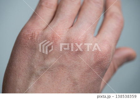 Male dry hand with symptoms of dehydration and prolonged exposure to cold weather without gloves. 138538359