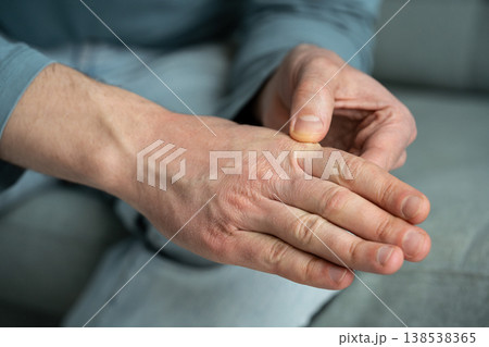 Man showing dry skin on hand and fingers with redness cracks and chapping, lack of hydration. Man showing dry skin on hand and fingers with redness cracks and chapping, lack of hydration. 138538365
