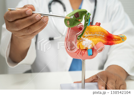Pancreatitis, pancreatic cancer, Asian doctor with pancreas, gallbladder and bile duct human anatomy model at hospital. 138542104