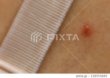 Closeup skin with acne moles and red spots. 138553685