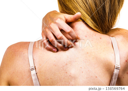 Woman with skin problem acne on back Woman with skin problem acne on back 138569764