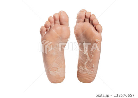 Peeling Skin on Human Foot Sole Close Up. Exfoliating Dead Skin on Human Foot Close Up. Foot Care Problem Peeling Skin Texture. Dry Peeling Skin on Foot Sole Detail. 138576657