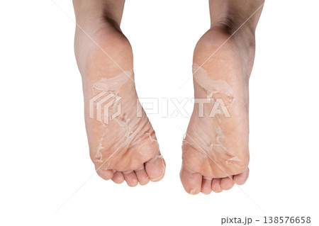 Peeling Skin on Human Foot Sole Close Up. Exfoliating Dead Skin on Human Foot Close Up. Foot Care Problem Peeling Skin Texture. Dry Peeling Skin on Foot Sole Detail. 138576658