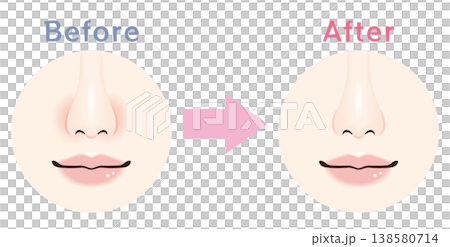 小鼻の赤み ビフォーアフター 比較イラスト 138580714