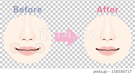 口周りのくすみ Before After イラスト 138580717