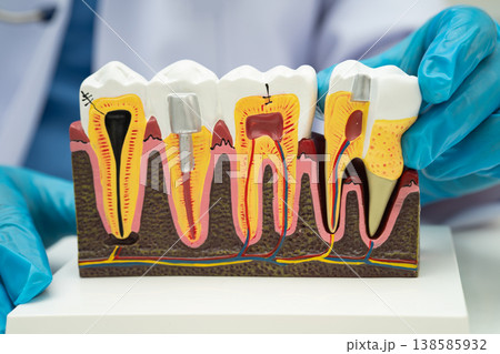 Asian dentist holding dental implant, artificial tooth roots into jaw, root canal of dental treatment, gum disease, teeth model for dentist. Asian dentist holding dental implant, artificial tooth roots into jaw, root canal of dental treatment, gum disease, teeth model for dentist. 138585932