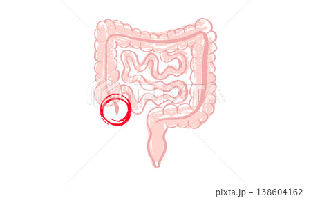 Inflamed appendix scetch 138604162