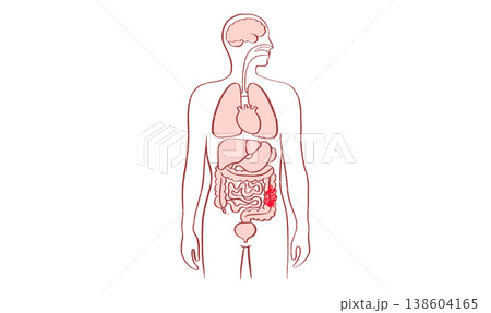 Intestine diseases sketch 138604165