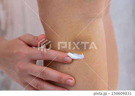 Unrecognized person rubbing recovery healing cream bruises on body at home scene. Close-up of woman with bruised leg. Bruising leg area, injury accident. Concept of home abuse. Consequences Unrecognized person rubbing recovery healing cream bruises on body at home scene. Close-up of woman with bruised leg. Bruising leg area, injury accident. Concept of home abuse. Consequences 138609831