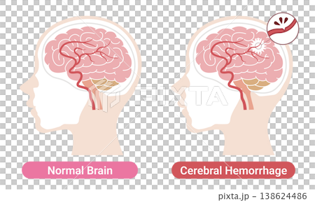 Comparison of a brain with a brain hemorrhage and a normal brain: Medical illustration (English version) 138624486