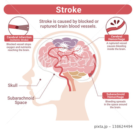 脳卒中の種類比較イラスト（脳梗塞・脳出血・くも膜下出血）英語版 138624494