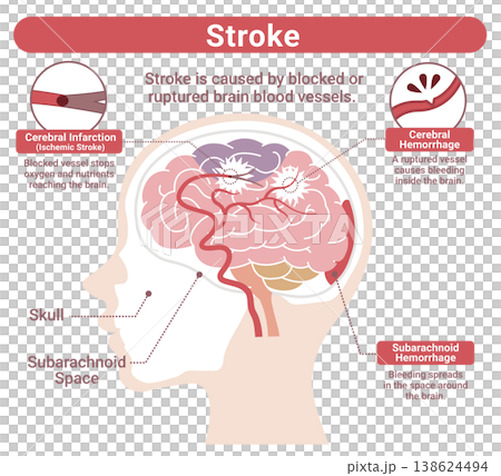 脳卒中の種類比較イラスト（脳梗塞・脳出血・くも膜下出血）英語版 138624494