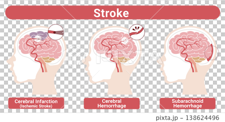 Types of Stroke (Cerebral Infarction, Cerebral Hemorrhage, Subarachnoid Hemorrhage) - Medical Illustrations (English Version) Types of Stroke (Cerebral Infarction, Cerebral Hemorrhage, Subarachnoid Hemorrhage) - Medical Illustrations (English Version) 138624496