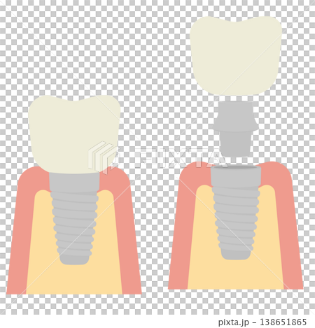 牙科植體示意圖 138651865