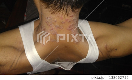 View of a young man neck. Dermatology, allergy, itching, red spot or rash on skin, health care and medical concept. 138662733