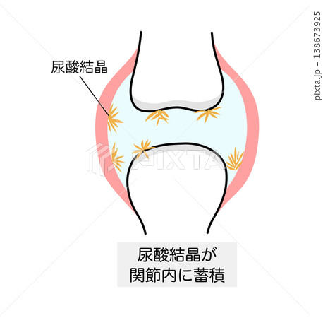 痛風における尿酸結晶が沈着した関節のイラスト 痛風における尿酸結晶が沈着した関節のイラスト 138673925
