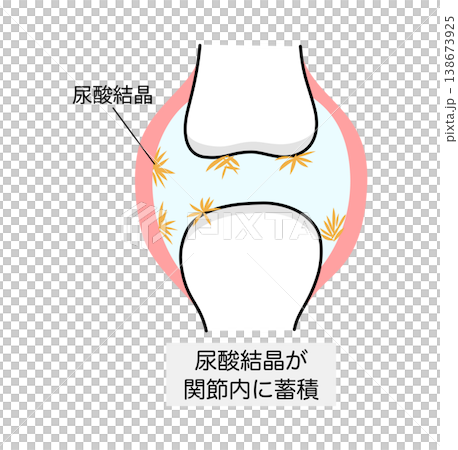 痛風における尿酸結晶が沈着した関節のイラスト 痛風における尿酸結晶が沈着した関節のイラスト 138673925