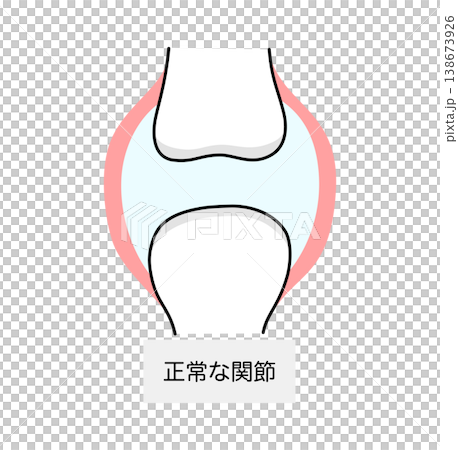 痛風患者正常關節示意圖 痛風患者正常關節示意圖 138673926