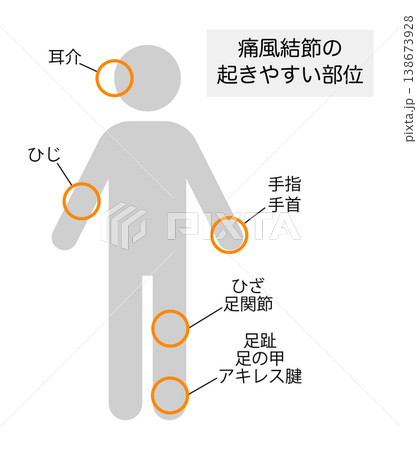 痛風結節が起きやすい部位を説明したイラスト 138673928