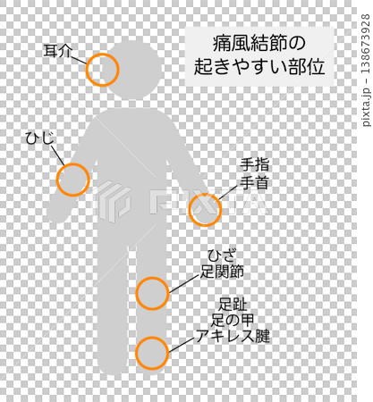 痛風結節が起きやすい部位を説明したイラスト 138673928