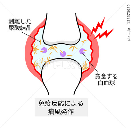 痛風発作を起こした関節のイラスト 138673929