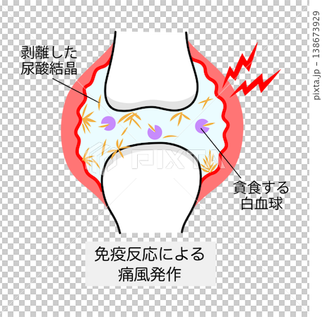 痛風発作を起こした関節のイラスト 138673929