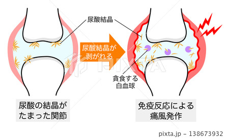 尿酸結晶が剥がれて痛風発作が起きた関節の比較イラスト 尿酸結晶が剥がれて痛風発作が起きた関節の比較イラスト 138673932