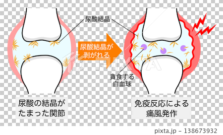 尿酸結晶が剥がれて痛風発作が起きた関節の比較イラスト 尿酸結晶が剥がれて痛風発作が起きた関節の比較イラスト 138673932