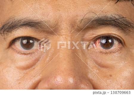 Blunt Eye Trauma , An eye impact injury causing potential damage to the eyeball. Blunt Eye Trauma , An eye impact injury causing potential damage to the eyeball. 138709663