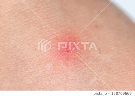 Close up view of flea bites on lower legs and feet skin. 138709669